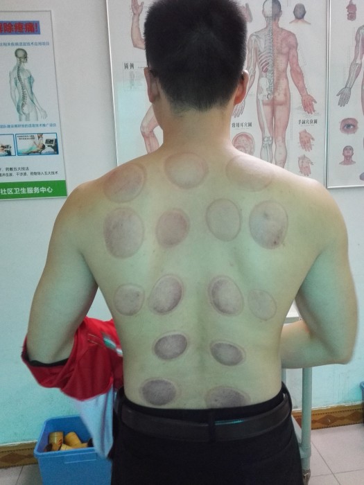拔火罐